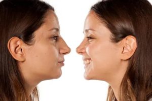 Rinoplastia en Madrid