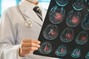 Del infarto cerebral al proyecto de vida: prevenir y rehabilitar para no llegar tarde.