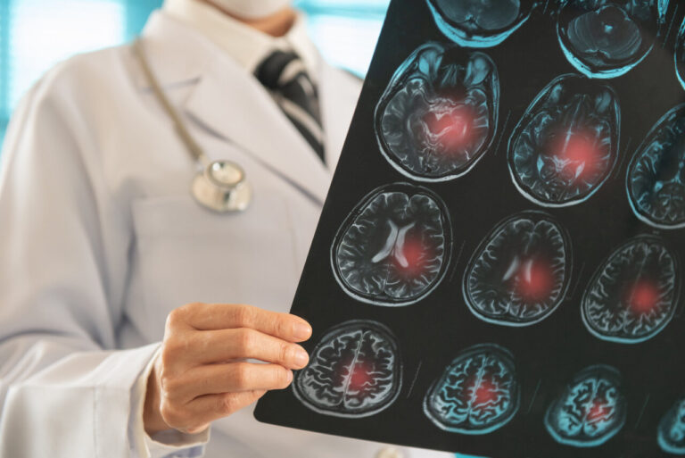 Del infarto cerebral al proyecto de vida: prevenir y rehabilitar para no llegar tarde.